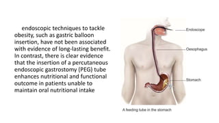 endoscopic techniques to tackle
obesity, such as gastric balloon
insertion, have not been associated
with evidence of long-lasting benefit.
In contrast, there is clear evidence
that the insertion of a percutaneous
endoscopic gastrostomy (PEG) tube
enhances nutritional and functional
outcome in patients unable to
maintain oral nutritional intake
 