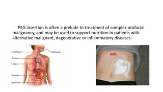 PEG insertion is often a prelude to treatment of complex orofacial
malignancy, and may be used to support nutrition in patients with
alternative malignant, degenerative or inflammatory diseases.
 