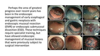 Perhaps the area of greatest
progress over recent years has
been in the endoscopic
management of early esophageal
and gastric neoplasia with
endoscopic mucosal resection
(EMR) or endoscopic submucosal
dissection (ESD). These techniques
require specialist training, but
have allowed endoscopic
management of mucosal lesions
that were previously subject to
surgical intervention
 