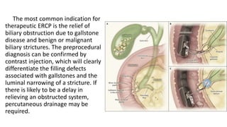 The most common indication for
therapeutic ERCP is the relief of
biliary obstruction due to gallstone
disease and benign or malignant
biliary strictures. The preprocedural
diagnosis can be confirmed by
contrast injection, which will clearly
differentiate the filling defects
associated with gallstones and the
luminal narrowing of a stricture. If
there is likely to be a delay in
relieving an obstructed system,
percutaneous drainage may be
required.
 