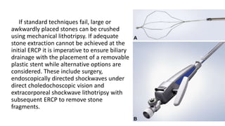 If standard techniques fail, large or
awkwardly placed stones can be crushed
using mechanical lithotripsy. If adequate
stone extraction cannot be achieved at the
initial ERCP it is imperative to ensure biliary
drainage with the placement of a removable
plastic stent while alternative options are
considered. These include surgery,
endoscopically directed shockwaves under
direct choledochoscopic vision and
extracorporeal shockwave lithotripsy with
subsequent ERCP to remove stone
fragments.
 