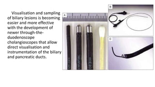 Visualisation and sampling
of biliary lesions is becoming
easier and more effective
with the development of
newer through-the-
duodenoscope
cholangioscopes that allow
direct visualisation and
instrumentation of the biliary
and pancreatic ducts.
 