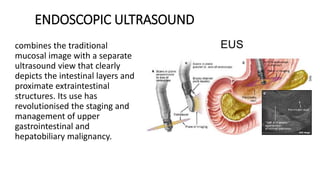 ENDOSCOPIC ULTRASOUND
combines the traditional
mucosal image with a separate
ultrasound view that clearly
depicts the intestinal layers and
proximate extraintestinal
structures. Its use has
revolutionised the staging and
management of upper
gastrointestinal and
hepatobiliary malignancy.
 