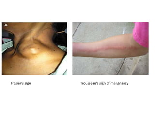 Trosier’s sign Trousseau’s sign of malignancy
 