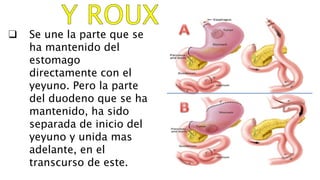 ❑ Se une la parte que se
ha mantenido del
estomago
directamente con el
yeyuno. Pero la parte
del duodeno que se ha
mantenido, ha sido
separada de inicio del
yeyuno y unida mas
adelante, en el
transcurso de este.
 