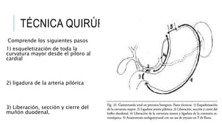 TÉCNICA QUIRÚRGICA
Comprende los siguientes pasos
1) esqueletización de toda la
curvatura mayor desde el píloro al
cardial
2) ligadura de la arteria pilórica
3) Liberación, sección y cierre del
muñón duodenal,
 