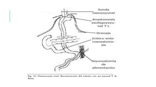 Gastrectomia billroth 1 y 2