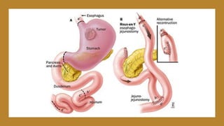 Gastrectomia billroth 1 y 2