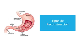 Tipos de
Reconstrucción
 