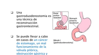 ❑ Una
gastroduodenostomia es
una técnica de
reconstrucción
gastrointestinal.
❑ Se puede llevar a cabo
en casos de un cáncer
de estomago, un mal
funcionamiento de la
válvula pilórica,
obstrucción gástrica y
 