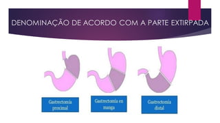 DENOMINAÇÃO DE ACORDO COM A PARTE EXTIRPADA
 