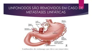 LINFONODOS SÃO REMOVIDOS EM CASO DE
METÁSTASES LINFÁTICAS
 