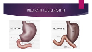 BILLROTH I E BILLROTH II
 