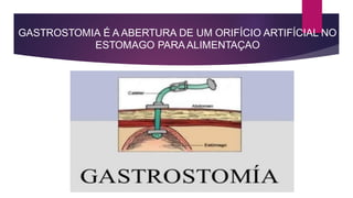 GASTROSTOMIA É A ABERTURA DE UM ORIFÍCIO ARTIFÍCIAL NO
ESTOMAGO PARA ALIMENTAÇAO
 