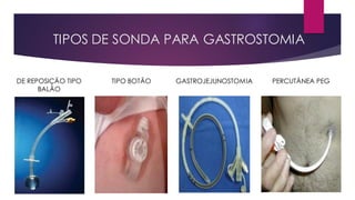 TIPOS DE SONDA PARA GASTROSTOMIA
DE REPOSIÇÃO TIPO
BALÃO
TIPO BOTÃO GASTROJEJUNOSTOMIA PERCUTÂNEA PEG
 