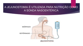 A JEJUNOSTOMIA É UTILIZADA PARA NUTRIÇÃO COMO
A SONDA NASOENTÉRICA
 
