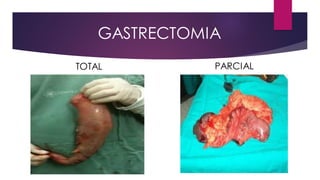 GASTRECTOMIA
TOTAL PARCIAL
 