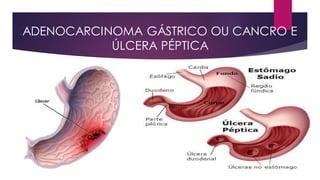 ADENOCARCINOMA GÁSTRICO OU CANCRO E
ÚLCERA PÉPTICA
 