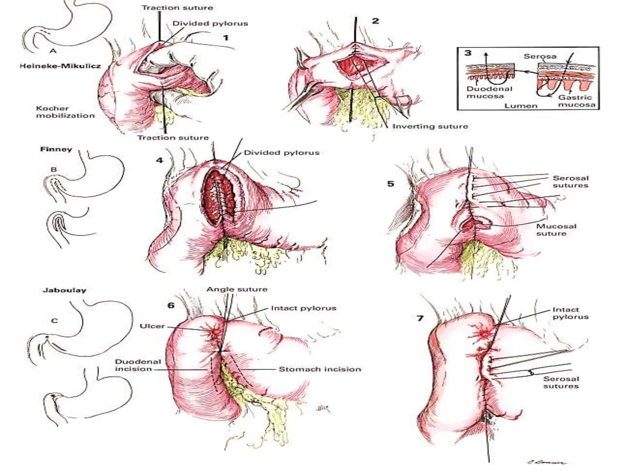 GASTRIC PERFORATION General Surgery pptx gastric-perforation-general-surgery-pptx