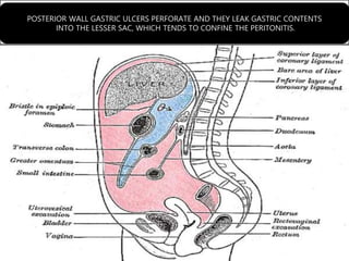 POSTERIOR WALL GASTRIC ULCERS PERFORATE AND THEY LEAK GASTRIC CONTENTS
INTO THE LESSER SAC, WHICH TENDS TO CONFINE THE PERITONITIS.
 