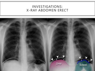 INVESTIGATIONS:
X-RAY ABDOMEN ERECT
 