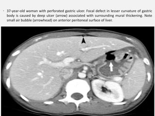 • 37-year-old woman with perforated gastric ulcer. Focal defect in lesser curvature of gastric
body is caused by deep ulcer (arrow) associated with surrounding mural thickening. Note
small air bubble (arrowhead) on anterior peritoneal surface of liver.
 