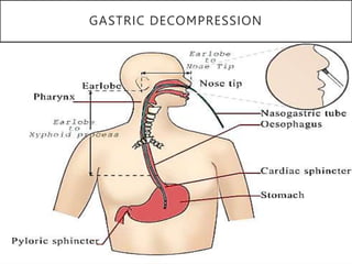 GASTRIC DECOMPRESSION
 