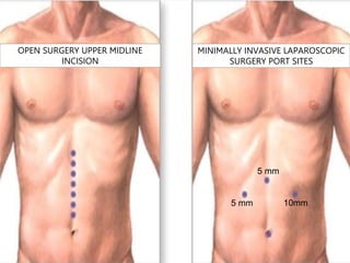 10mm
5 mm
5 mm
OPEN SURGERY UPPER MIDLINE
INCISION
MINIMALLY INVASIVE LAPAROSCOPIC
SURGERY PORT SITES
 