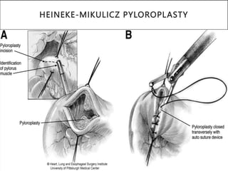 HEINEKE-MIKULICZ PYLOROPLASTY
 