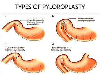TYPES OF PYLOROPLASTY
 