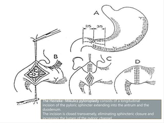 The Heineke−Mikulicz pyloroplasty consists of a longitudinal
incision of the pyloric sphincter extending into the antrum and the
duodenum.
The incision is closed transversely, eliminating sphincteric closure and
increasing the lumen of the pyloric channel.
 
