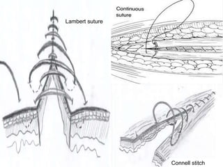 Lambert suture
Connell stitch
 