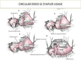 CIRCULAR ENDO GI STAPLER USAGE
 