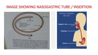 IMAGE SHOWING NASOGASTRIC TUBE / INSERTION
 