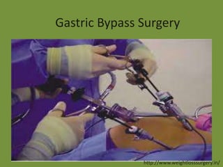 Gastric Bypass Surgery

http://www.weightlosssurgery.in/

 
