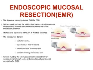 ENDOSCOPIC MUCOSAL
RESECTION(EMR)
• The Japanese have popularized EMR for EGC.
• This approach involves the submucosal injection of fluid to elevate
the lesion and facilitate complete mucosal resection under
endoscopic guidance.
• There is less experience with EMR in Western countries.
• The procedure is done in
• well-differentiated,
• superficial type IIa or IIc lesions
• smaller than 3 cm in diameter and
• located in an easily manipulated area.
• Tumors invading the submucosa are at increased risk for
metastasizing to lymph nodes and are not usually considered
candidates for EMR.
 