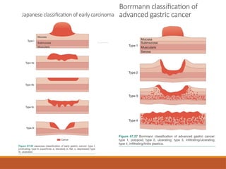Boreman Classification Gastric Cancer Management Overview complete | PPTX