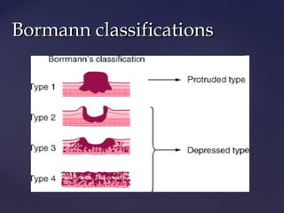 Boreman Classification Gastric Cancer | PPT