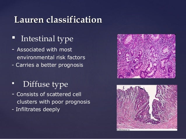 Diffuse Vs Intestinal Gastric Cancer Usmle
