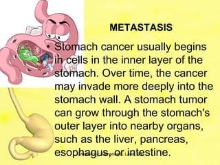 METASTASIS
• Stomach cancer usually begins
  in cells in the inner layer of the
  stomach. Over time, the cancer
  may invade more deeply into the
  stomach wall. A stomach tumor
  can grow through the stomach's
  outer layer into nearby organs,
  such as the liver, pancreas,
  esophagus, or intestine.
      Created by: Katherine L. Laud, SN
 