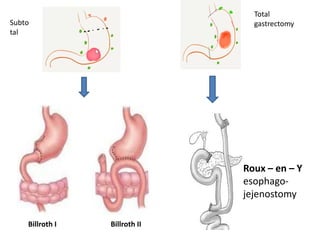 Step By Step Resternotomy Gastric carcinoma | PDF