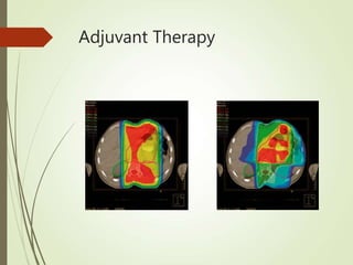 Adjuvant Therapy
 