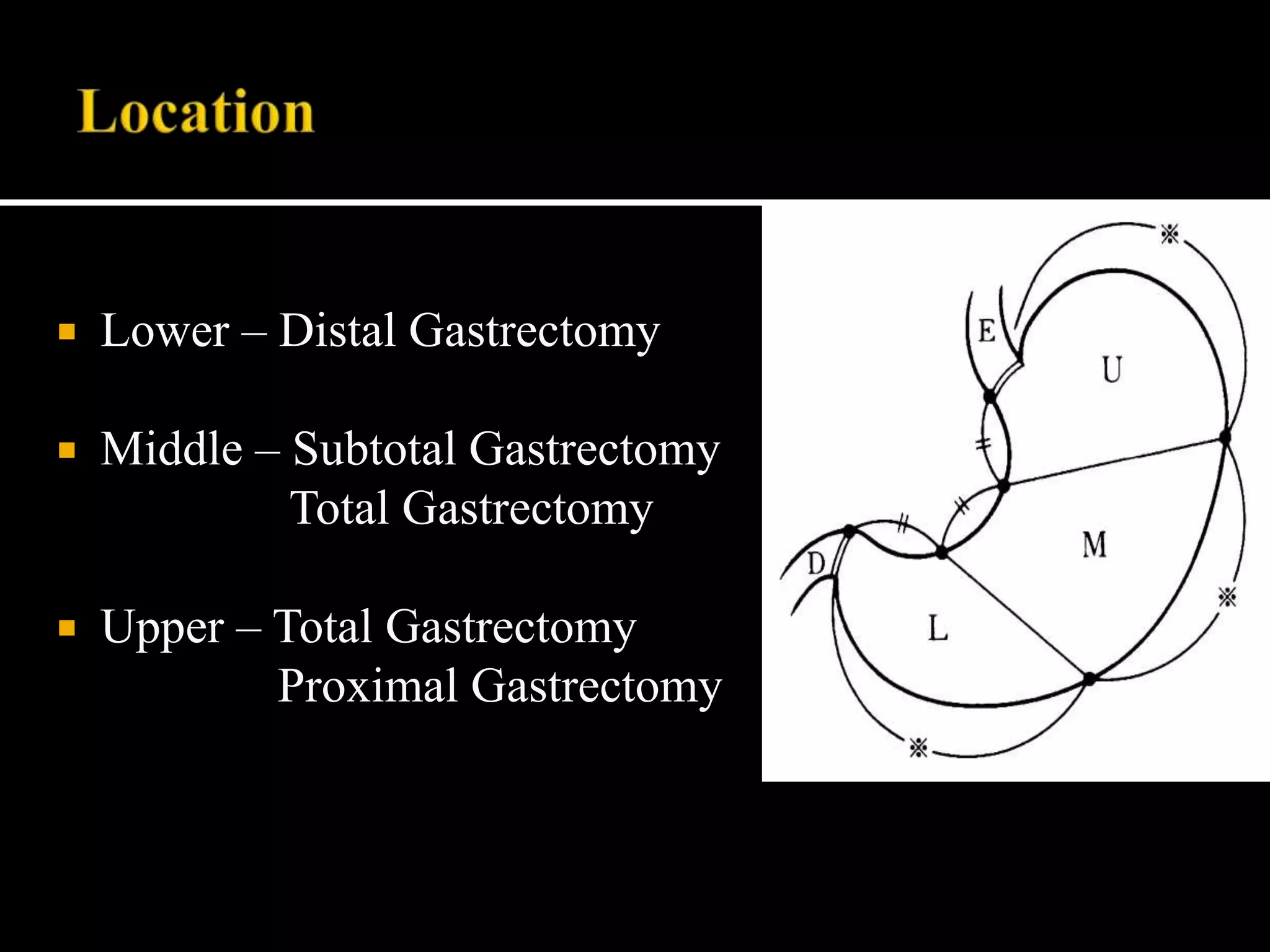 Gastric cancer- surgical management.pptx