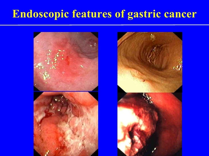 stomach tumor advanced stomach cancer pictures to pin on pinsdaddy stomach tumor advanced stomach cancer pictures to pin on pinsdaddy