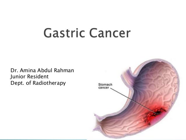Gastric Cancer Investigations And Management - 