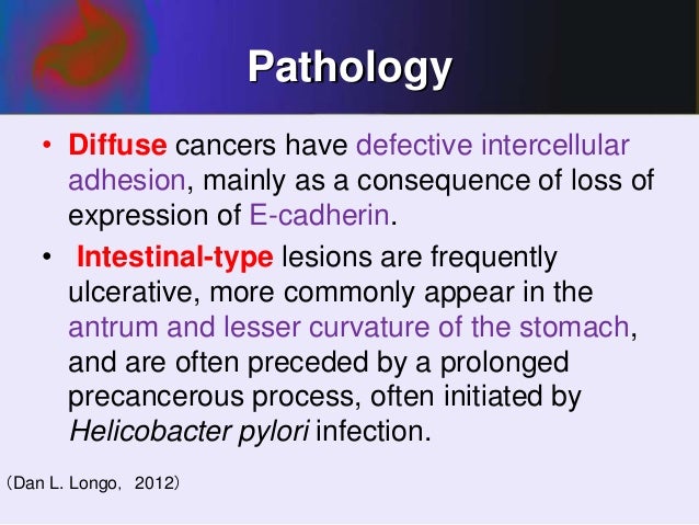 Diffuse Vs Intestinal Gastric Cancer Usmle