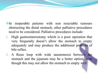 Barium meal showing infiltrating gastric carcinoma in the region of the incisura. There is irregular narrowing affecting both the lesser and greater curvatures (arrow) ‘Apple core sign”