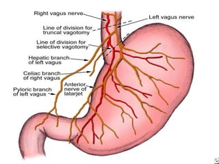 Controversies with respect to operability include patients with:N3 nodal involvementInvolvement of the adjacent peritoneumRemaining patients are considered operable and should undergo curative resection. Most of the patients should have neoadjuvant chemotherapy as it improves survival.Total gastrectomyThe operation is best performed through a long upper midline incision. The stomach is removed en bloc, including the tissues of the entire greater omentum and lesser omentum. The transverse colon is completely separated from the greater omentum.