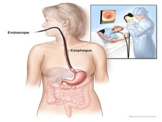 The blind open end of the Roux loop may then be closed either with sutures or with a linear stapler. The Roux loop may be placed in either, an anticolic or retrocolic position.The jejunojejunostomy is undertaken in the usual fashion(end to side).