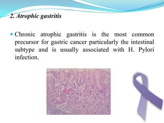 4. Gastric remnant cancer stomach cancer can develop, usually years following distal gastrectomy or gastroenterostomy.5. Other premalignant states:Patients with hereditary, non polyposis colorectal cancer have a 10% risk of developing gastric cancer.Ménétrier's disease: gastric mucosal hypertrophy.